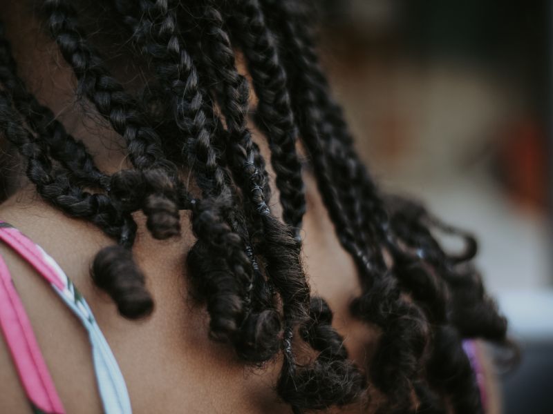 dandruff and seborrheic dermatitis in black people