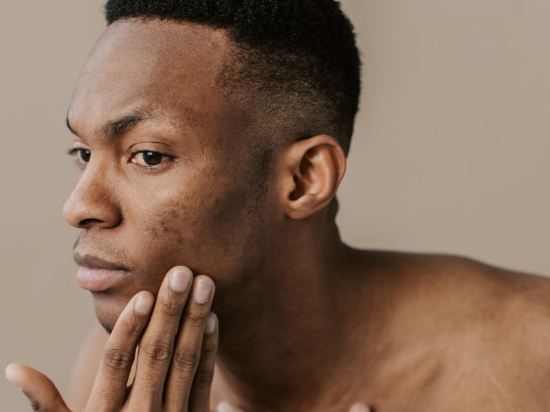 How Seborrheic Dermatitis Affects Black People: Symptoms, Causes, & Treatment