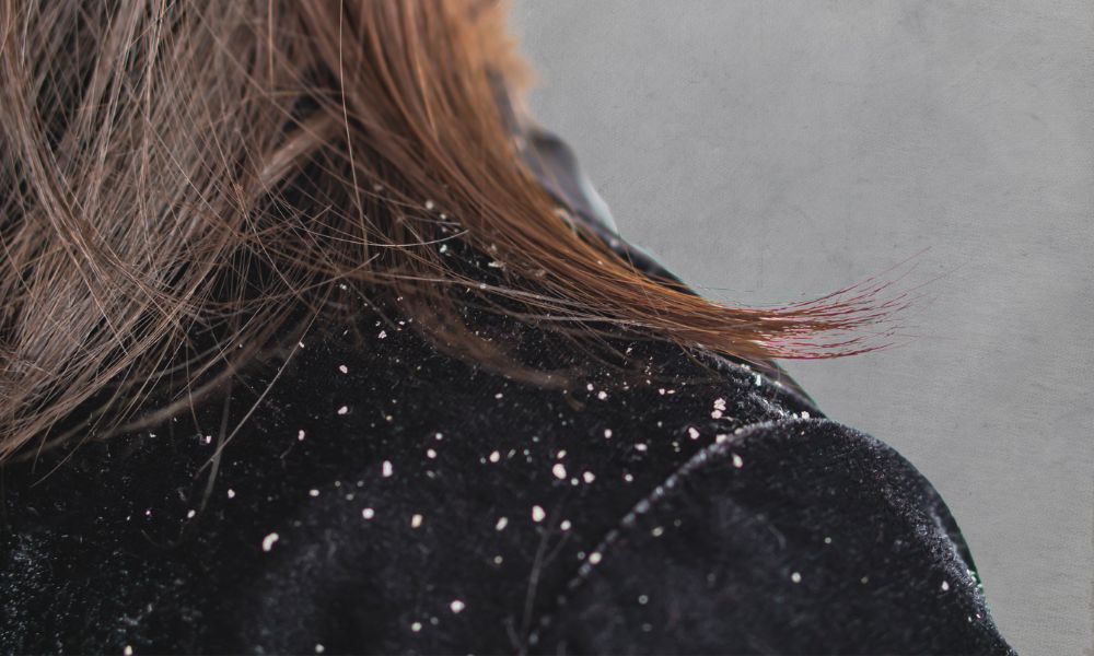 dandruff on woman's shoulders; popular dandruff myths and natural remedies