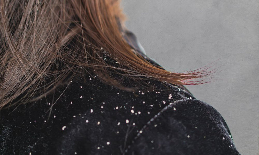 5 Myths About Dandruff &amp; Natural Solutions For Dandruff Management