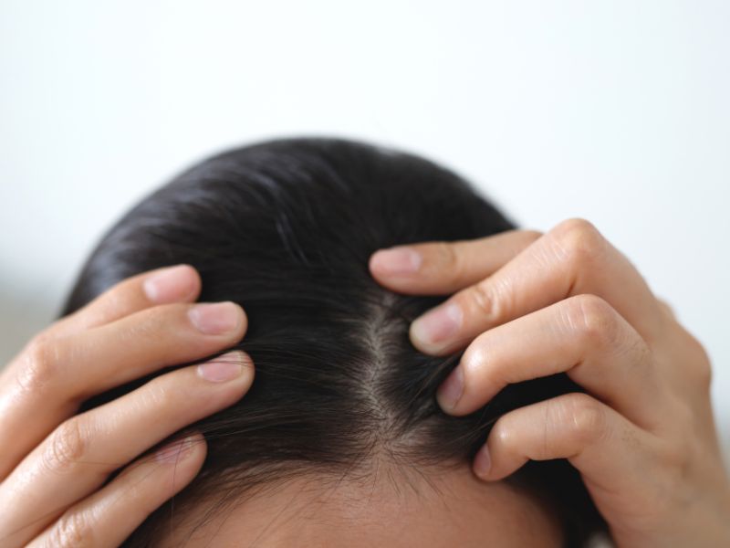 scalp issues like dandruff and dry scalp