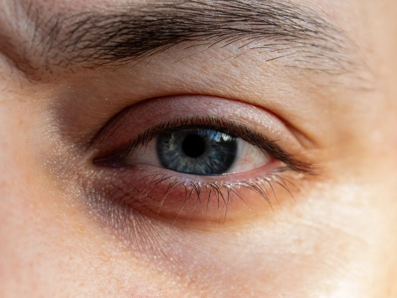 eyebrow dandruff and seborrheic dermatitis