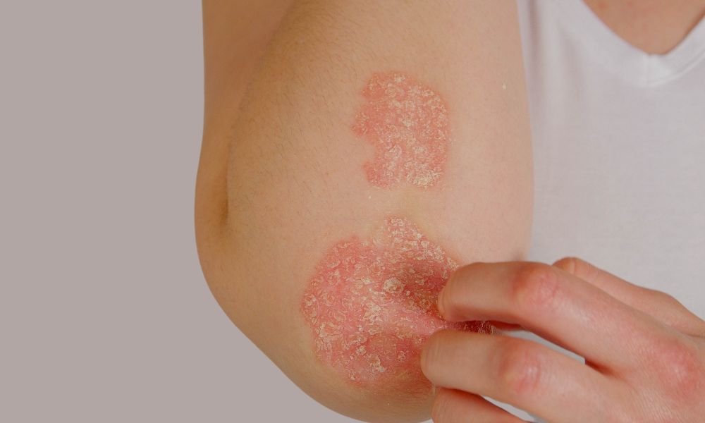 comparing psoriasis to seborrheic dermatitis, symptoms treatment options, and causes